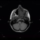 Fibrous dysplasia of the left maxillary sinus: MRI - Magnetic Resonance Imaging
